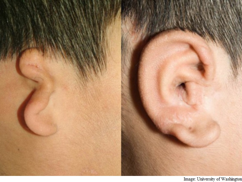 Surgeons Carve New Ears Using 3D Printings