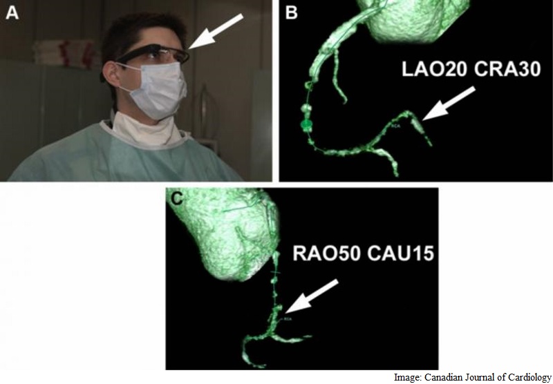 Google Glass Helps Cardiologists Open Blocked Heart Artery