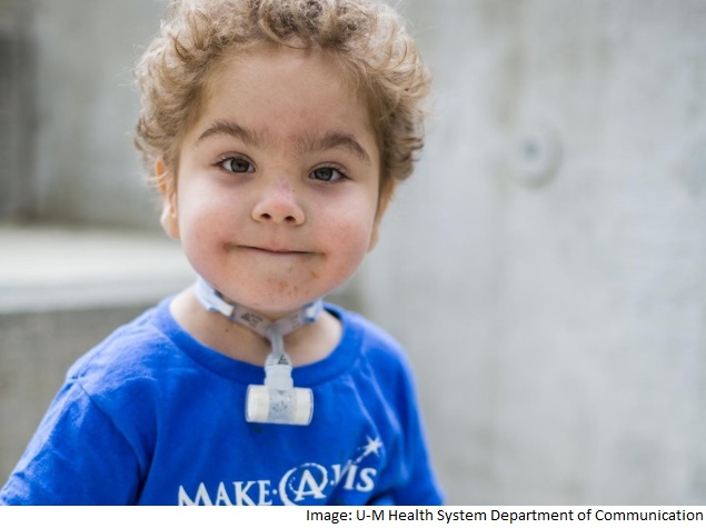 3D-Printed Splints Help Infants With Airway Disorder: US Researchers