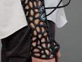 3D-printed plaster cast that reduces healing time by 40 percent