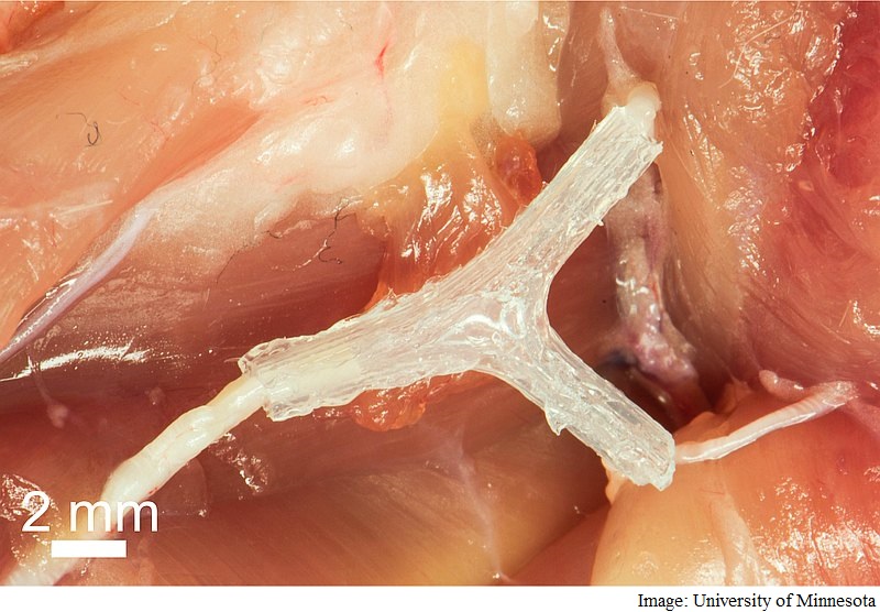3D-Printed Guide Helps Regrow Nerve After Injury