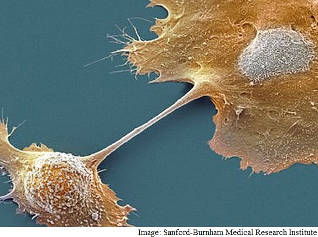 Scientists Find Way to Restore Pancreatic Cancer Cells to Normal State